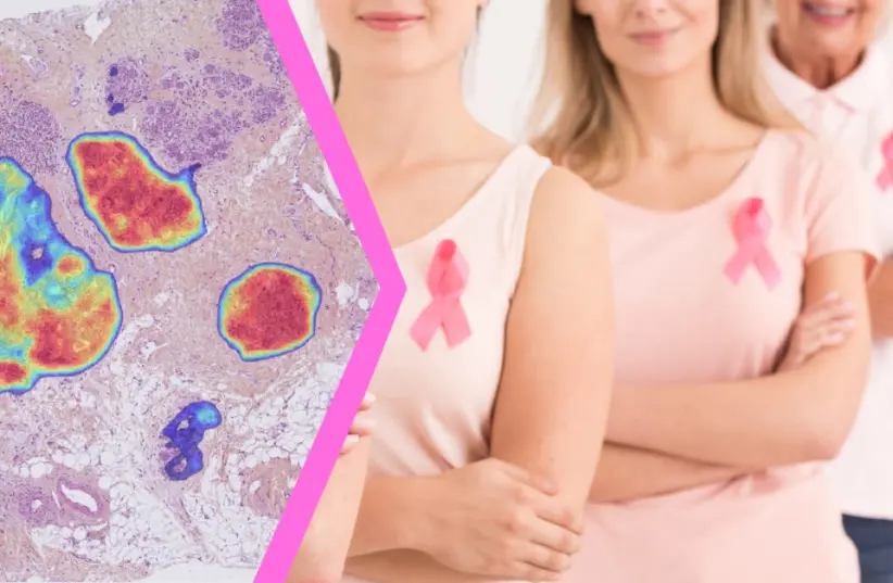 Cáncer-de-seno mama